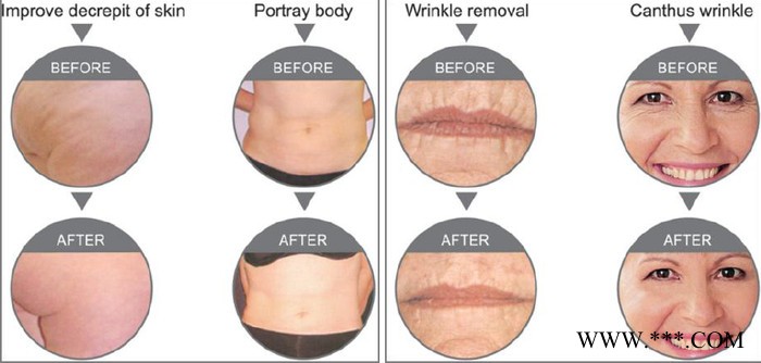 SVATAR RF美容仪RF射频美容仪/提拉紧致祛皱塑型美容仪图4