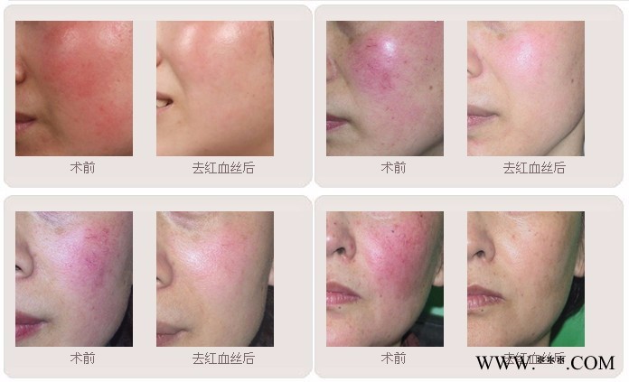 980红血丝治疗仪 净丝仪 **效的红血丝去除仪器   美容材料及用具图4