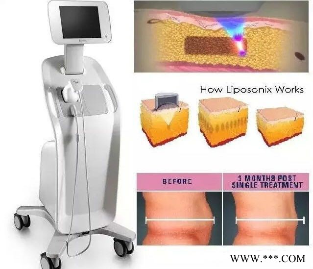 热立塑减肥机  聚焦声波溶脂仪 美体塑形仪 优立塑减肥仪广州**美容仪器图2