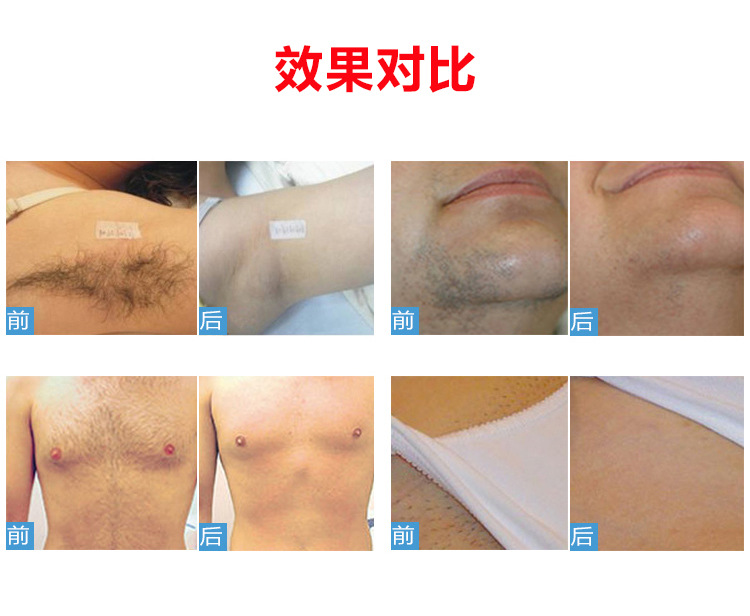 808激光脱毛仪详情页_11