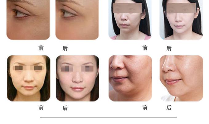 电波拉皮系列