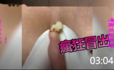 03:04 医学科普---挤粉瘤爆浆与不爆浆的区别